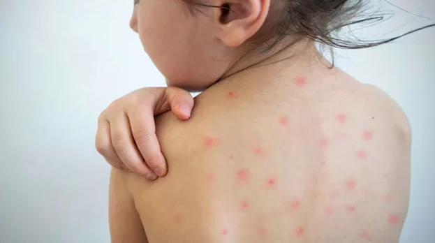 হাম থেকে শিশুদের বাঁচাতে যেসব জানা জরুরি - image